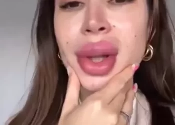 Preenchimento que influencer fez rendeu inchaço e dor. Como é processo para retirar?