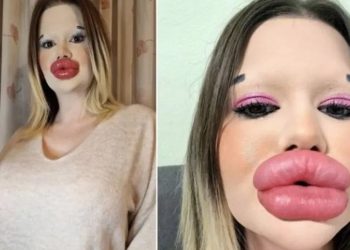 DONA DOS ‘MAIORES LÁBIOS DO MUNDO’ NÃO CONSEGUE ENCONTRAR AMOR